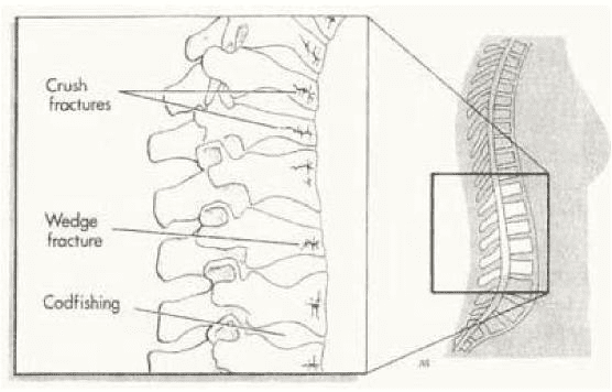 vertebral-fracture-patterns